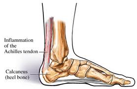 Identify Your Pain: Achilles Tendonitis