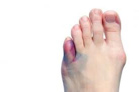 Broken toe