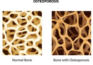 osteoporosis, aging feet