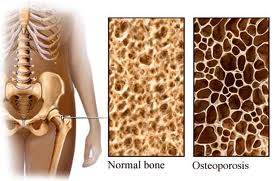 Bone density