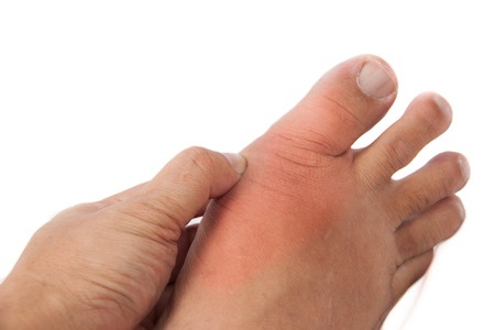 Gout Inflammation
